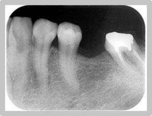 インプラント・ホワイトニング レントゲン写真