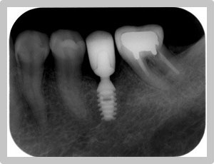 インプラント・ホワイトニング レントゲン写真